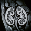 МРТ наднирників