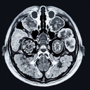 МРТ малого тазу у жінок